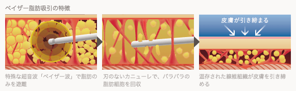 ベイザー脂肪吸引の特徴
