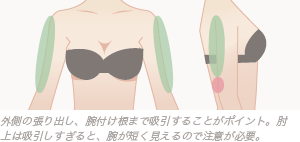 外側の張り出し、腕付け根まで吸引することがポイント。肘上は吸引しすぎると、腕が短く見えるので注意が必要。