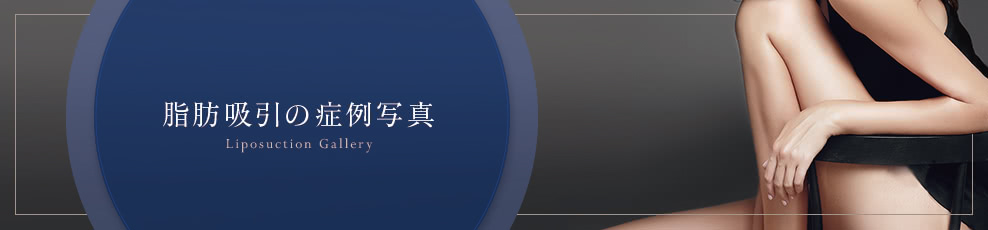 脂肪吸引の症例写真