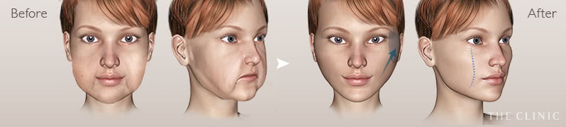 糸を使ったリフト Before / After